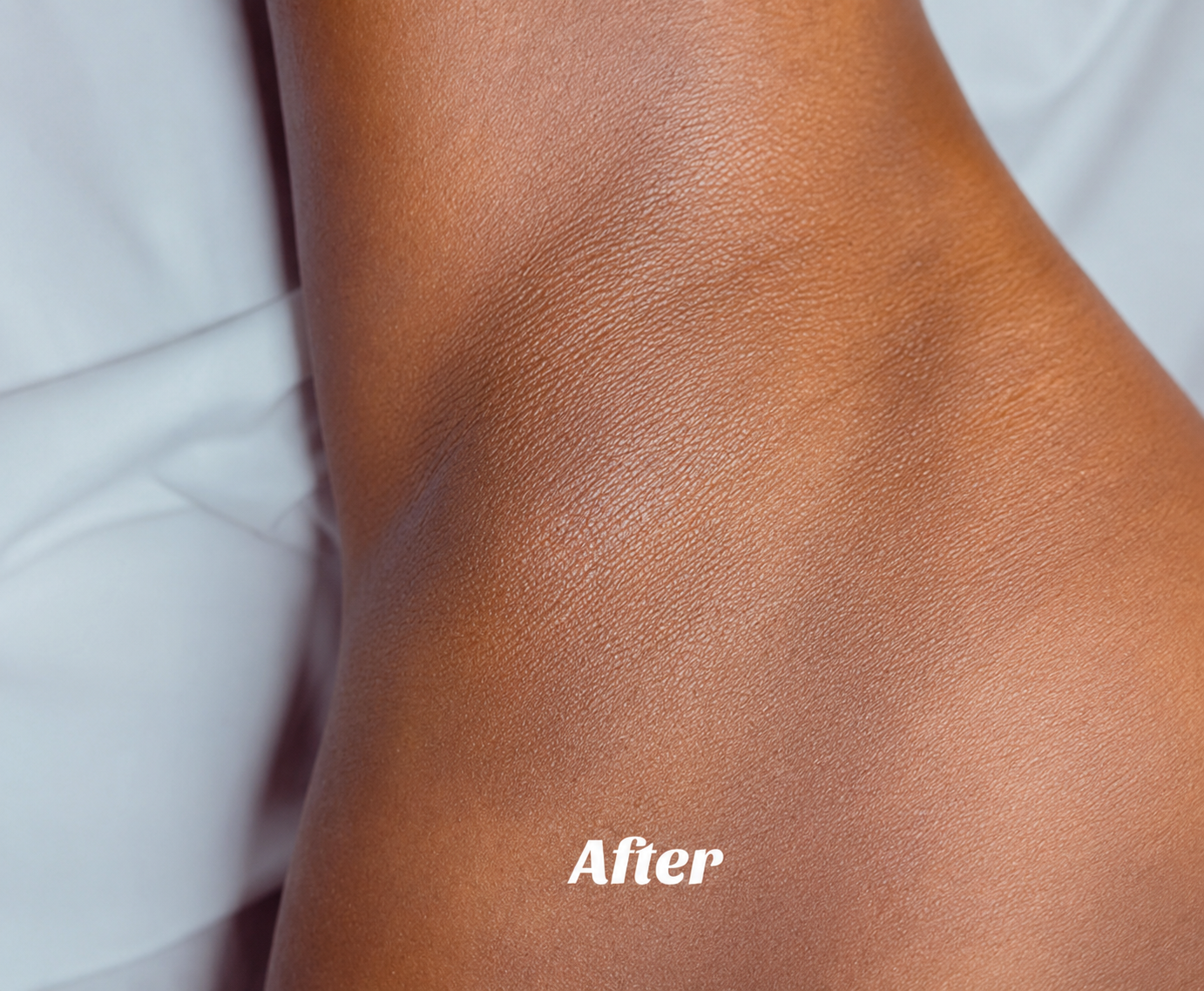 Epidermal Resurfacing Result