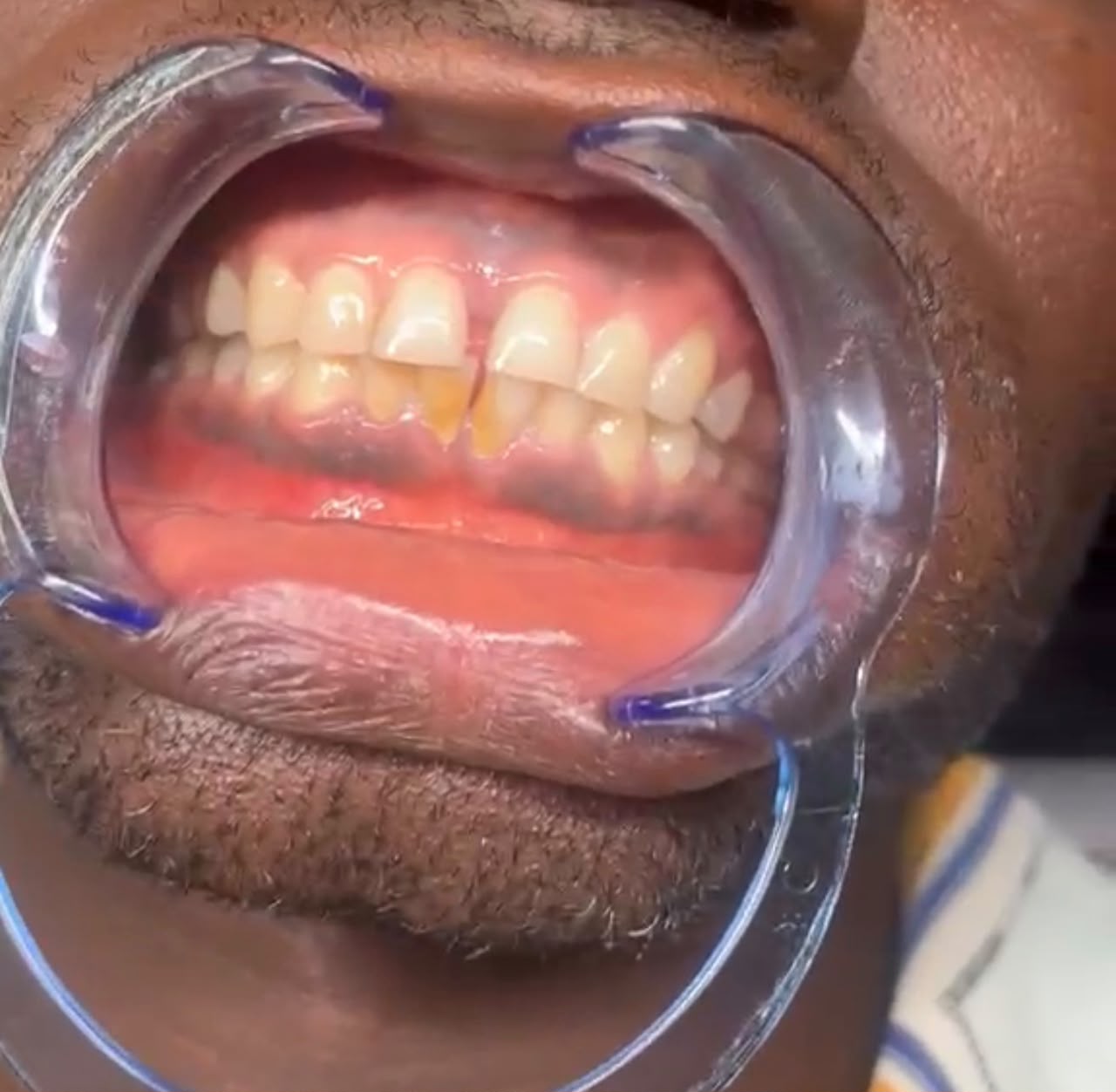 Smile transformation