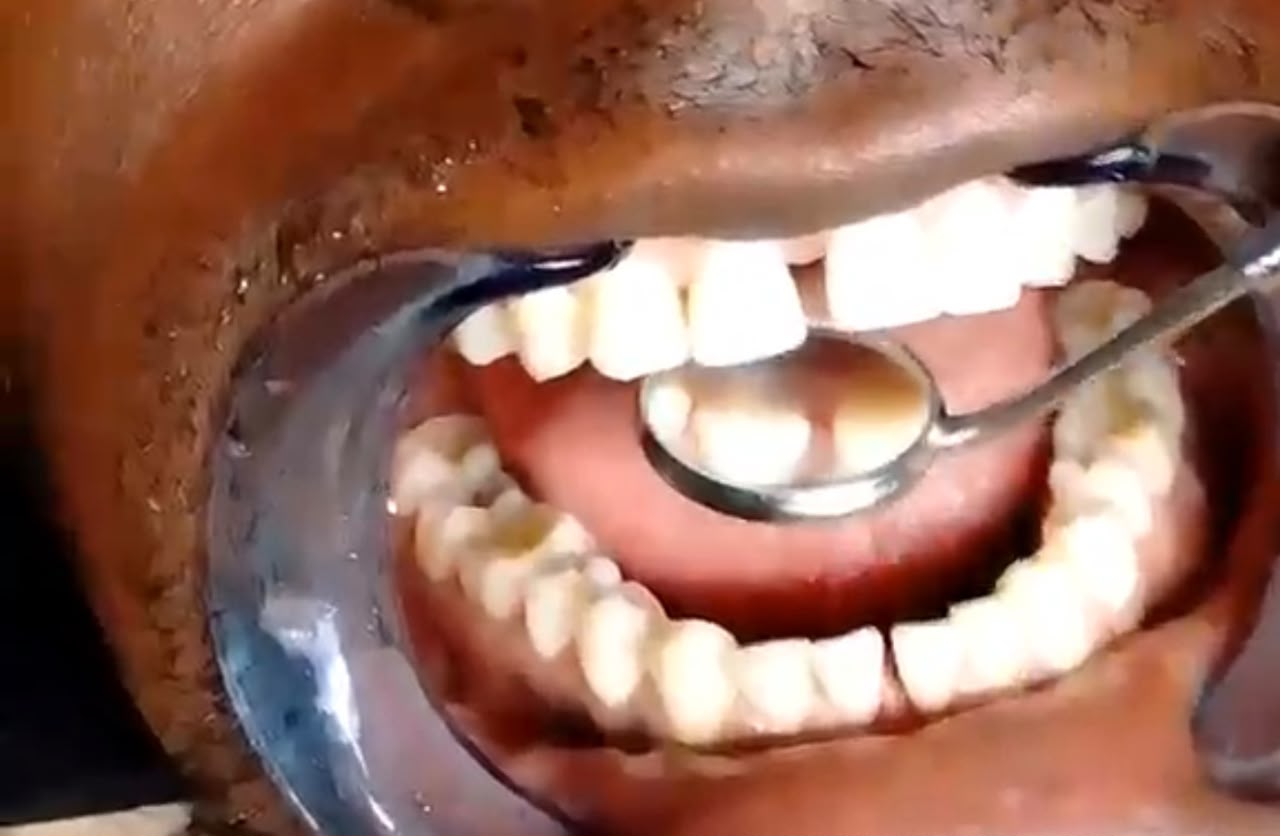 Teeth whitening
