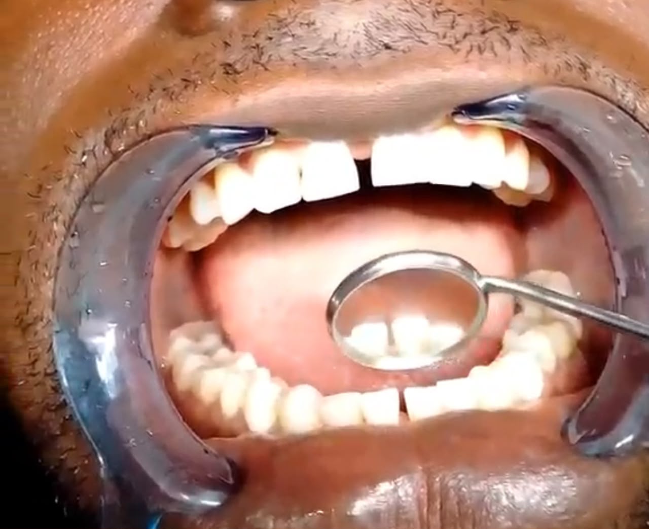 Teeth whitening