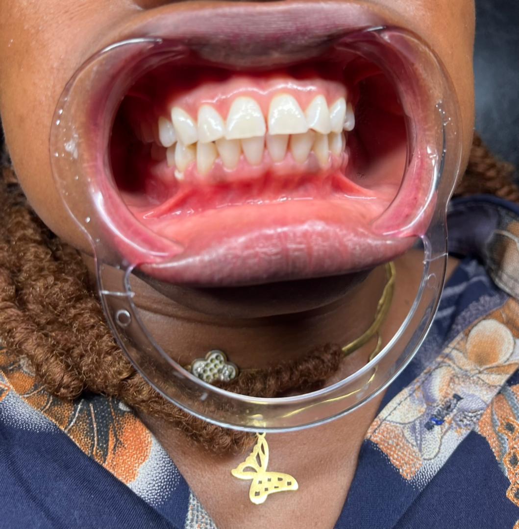 Dental whitening